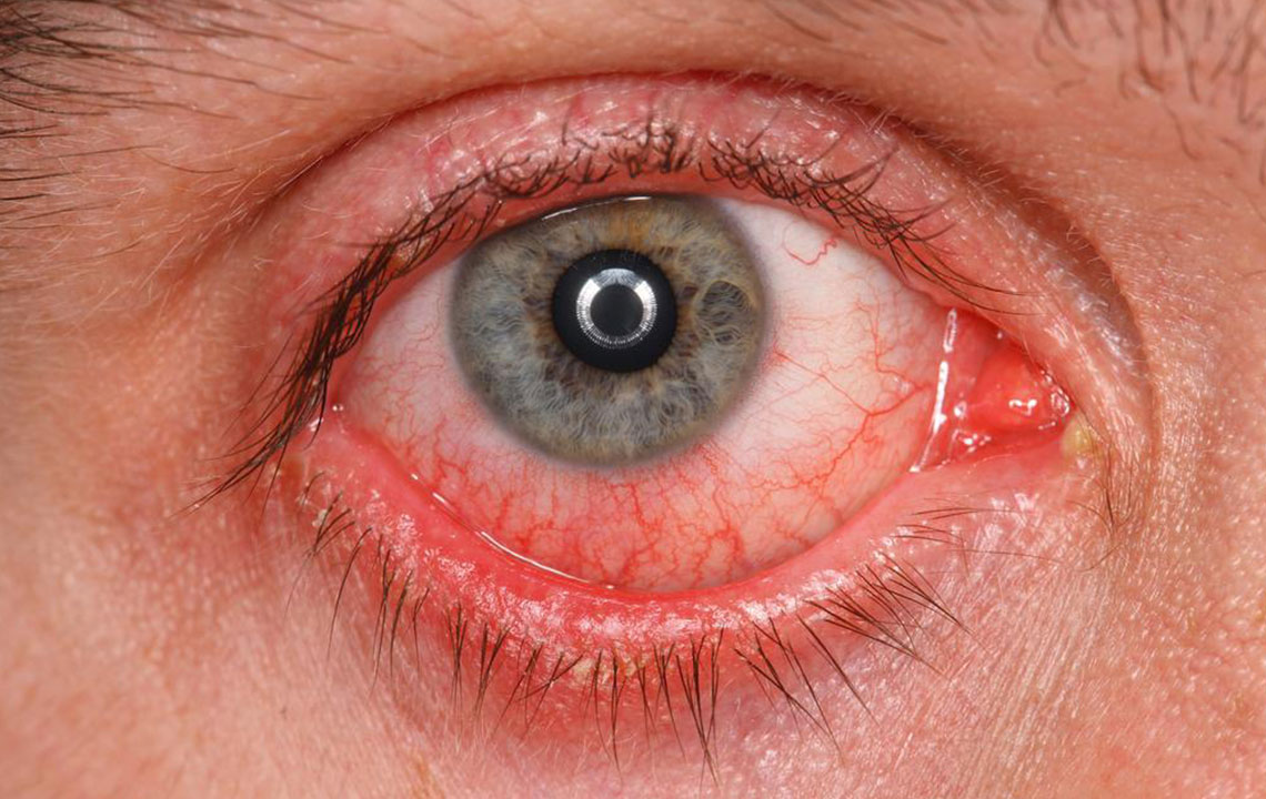 A Few Common Symptoms, Causes, And Treatments of Pink Eyes