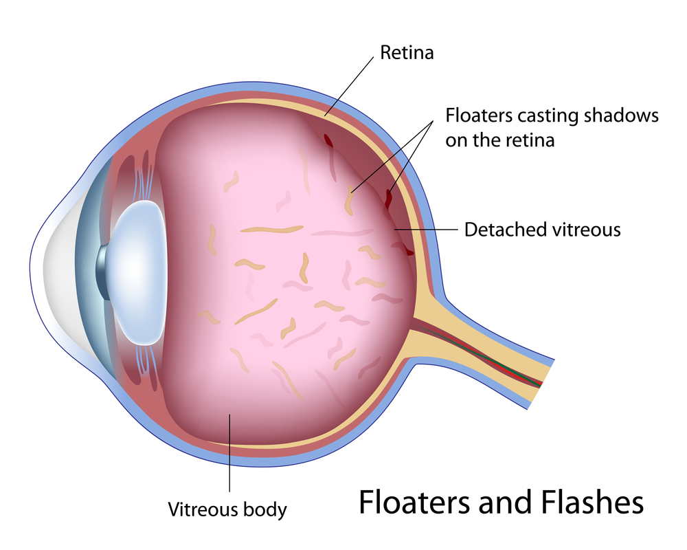 All About Eye Floaters And How To Get Rid Of Them