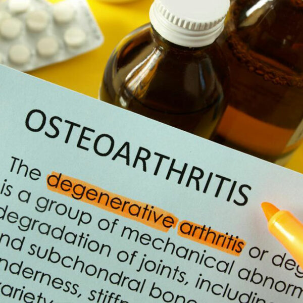 Best Treatment Options for Osteoarthritis of the Knee