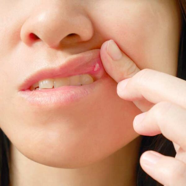 Common Reasons for Sores in the Mouth