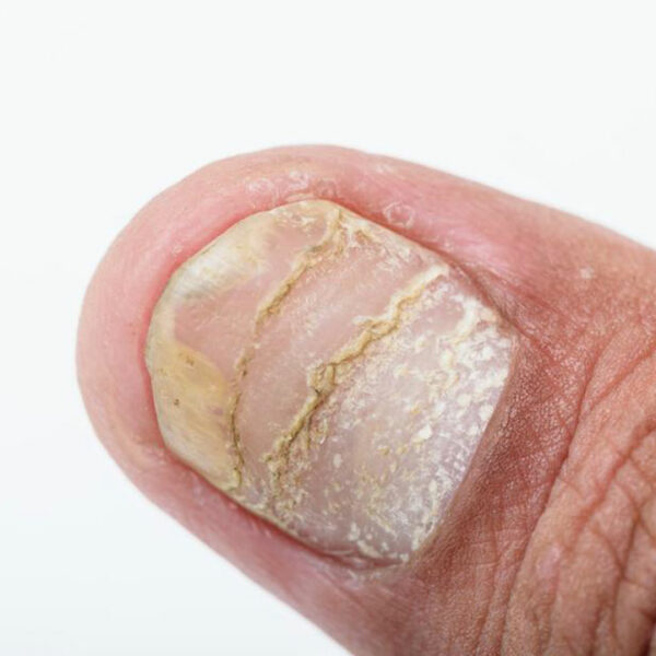 Different types of nail diseases and their causes