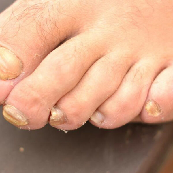 Get rid of toenail fungus with these home remedies