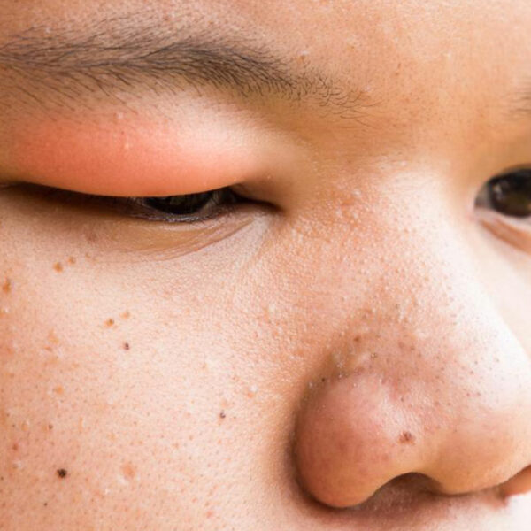 Here&#8217;s How to Get Rid of a Stye With These Simple Steps