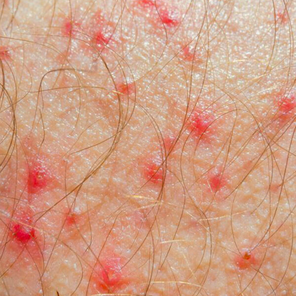 Know Everything about Atopic Dermatitis