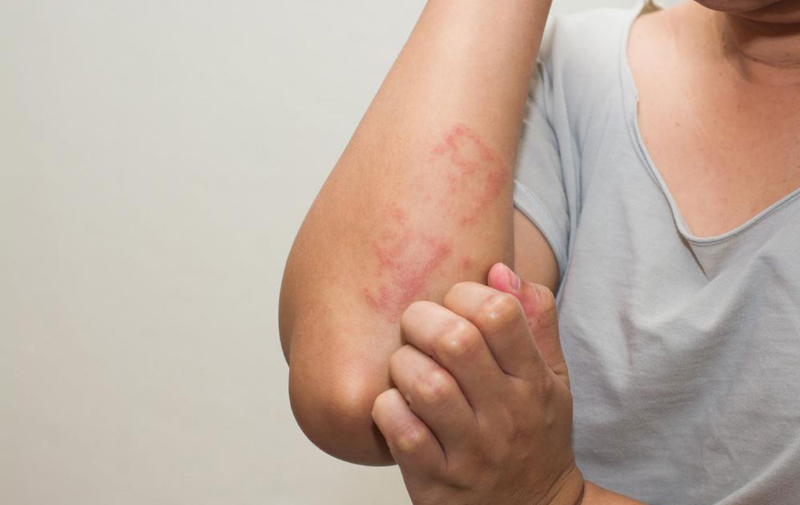 Lupus Skin Rash &#8211; Symptoms and Treatment