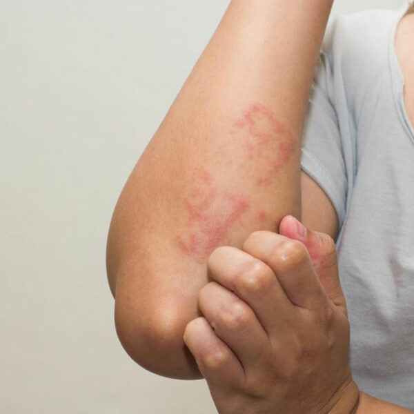 Signs and Symptoms of Lupus You Need to Be Aware Of