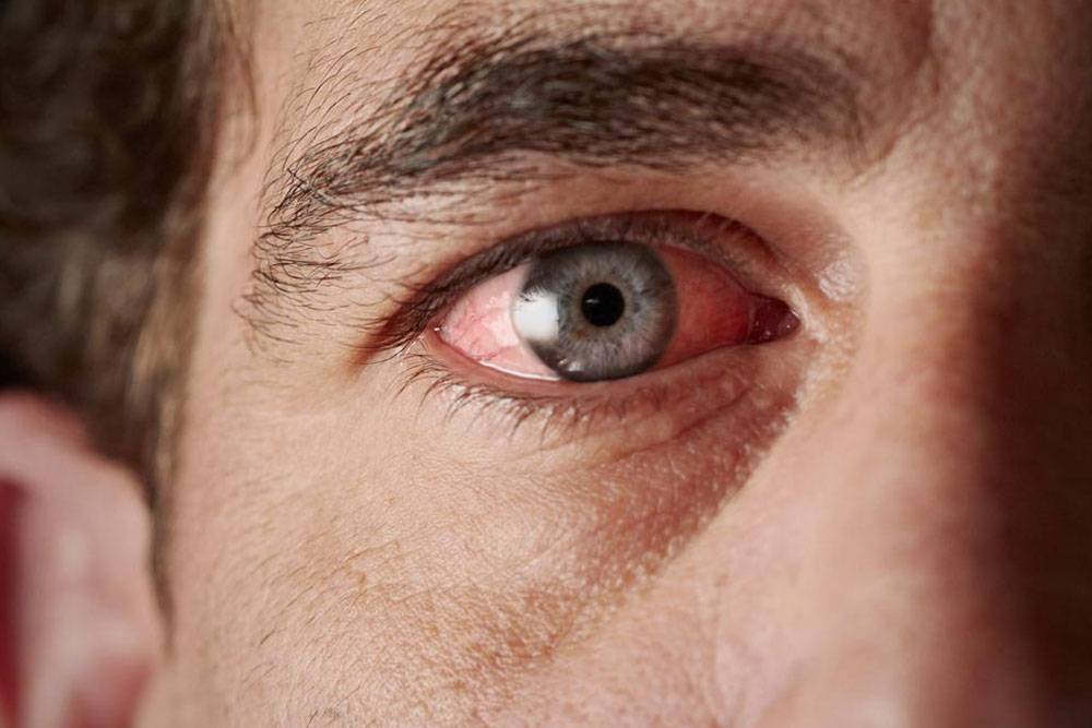 Sjogren&#8217;s Syndrome- Causes and Symptoms