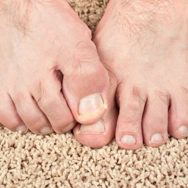 Some Effective Home Remedies for Toenail Fungus