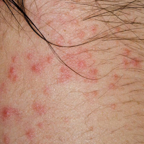 Types of Eczematous Dermatitis and Their Symptoms