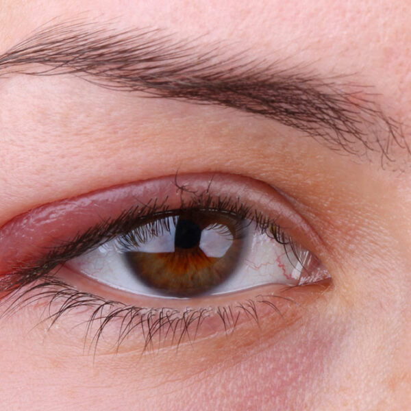 Top 3 conditions that affect eye health