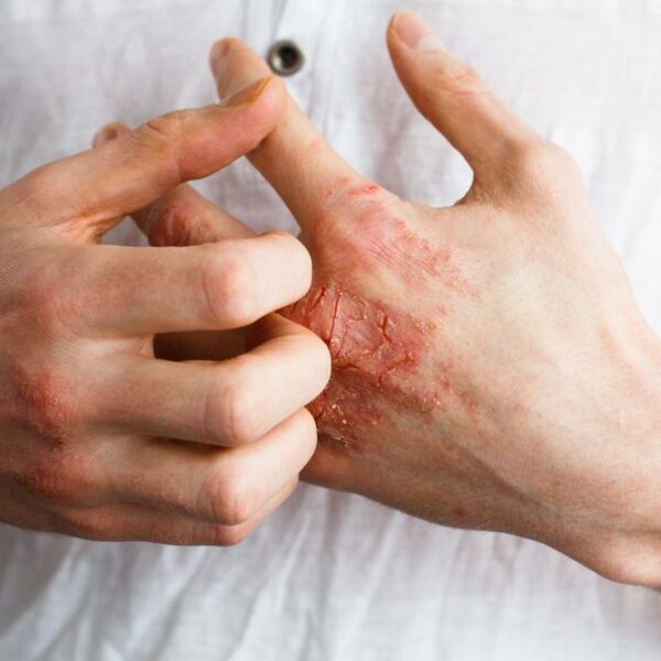 Treatment methods for eczema