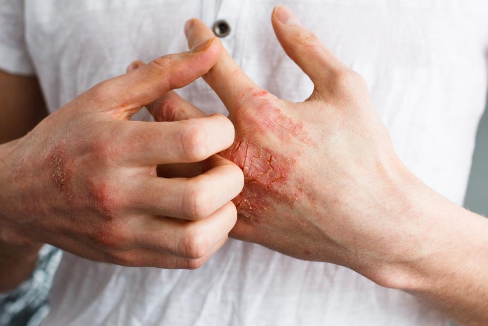 Treatment methods for eczema