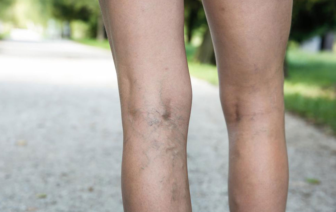 What You Need to Know about Deep Vein Thrombosis