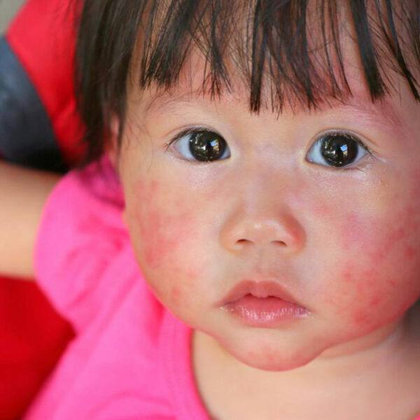 4 useful tips to treatment of atopic dermatitis in children