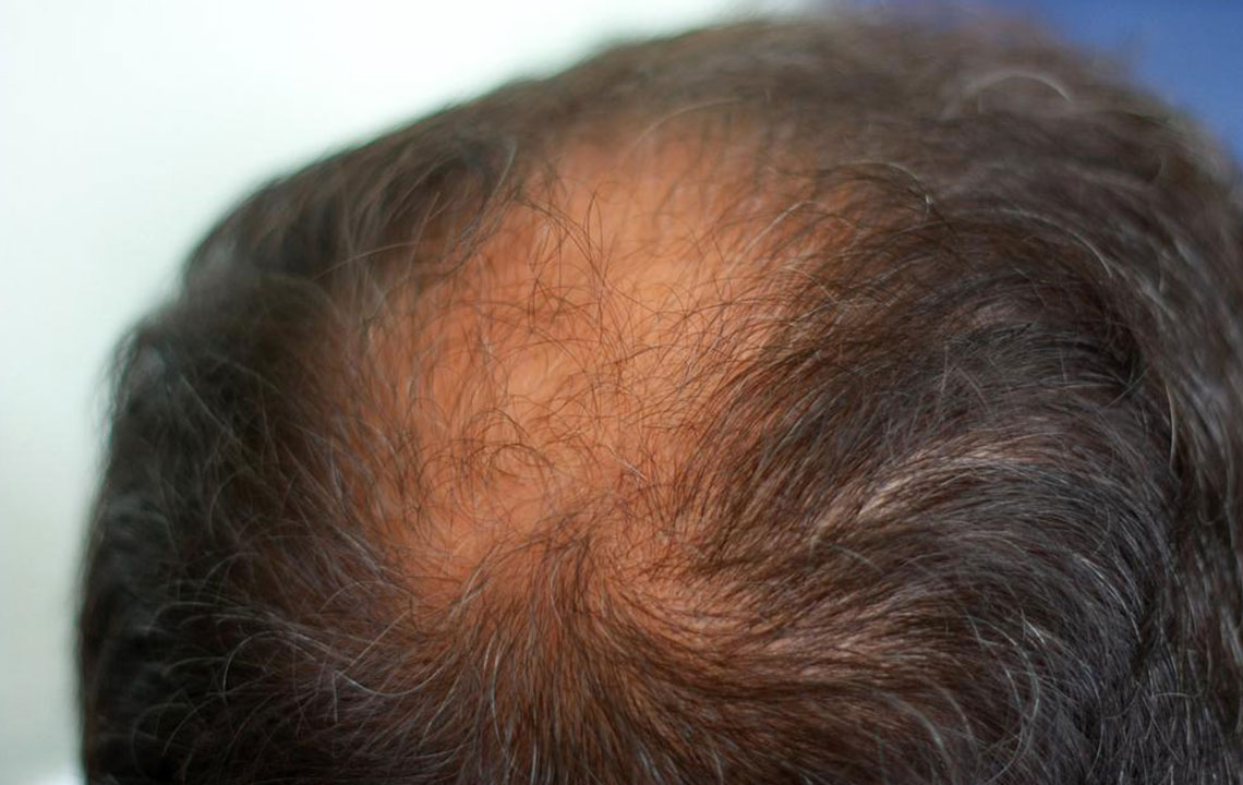 8 Effective Home Remedies for Thinning Hair